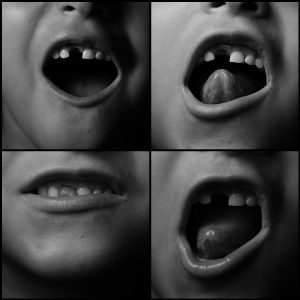 Collage van 4 foto's waarop een kindermond te zien is met een gebit waar een tand uit is