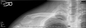 Een röntgenfoto van een gebroken sleutelbeen